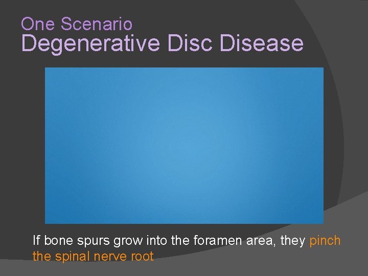 One Scenario Degenerative Disc Disease If bone spurs grow into the foramen area, they