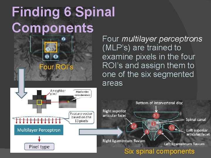 Finding 6 Spinal Components 1 Four ROI’s Four multilayer perceptrons (MLP’s) are trained to