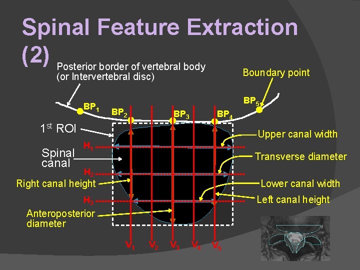 Spinal Feature Extraction (2) Posterior border of vertebral body Boundary point (or Intervertebral disc)