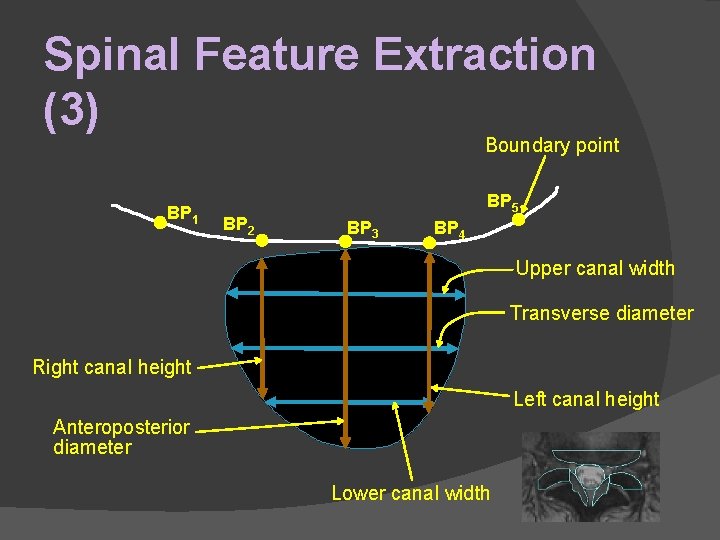 Spinal Feature Extraction (3) Boundary point BP 1 BP 2 BP 5 BP 3