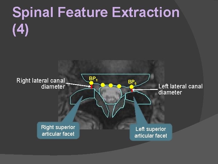 Spinal Feature Extraction (4) Right lateral canal diameter Right superior articular facet BP 1