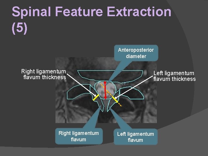 Spinal Feature Extraction (5) Anteroposterior diameter Right ligamentum flavum thickness Right ligamentum flavum Left