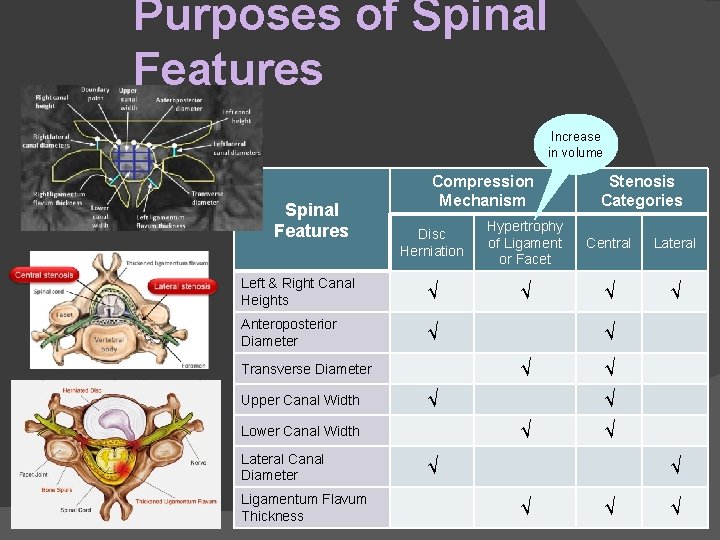 Purposes of Spinal Features Increase in volume Spinal Features Compression Mechanism Stenosis Categories Disc