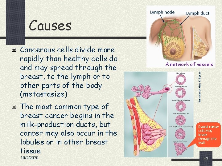 Causes The most common type of breast cancer begins in the milk-production ducts, but