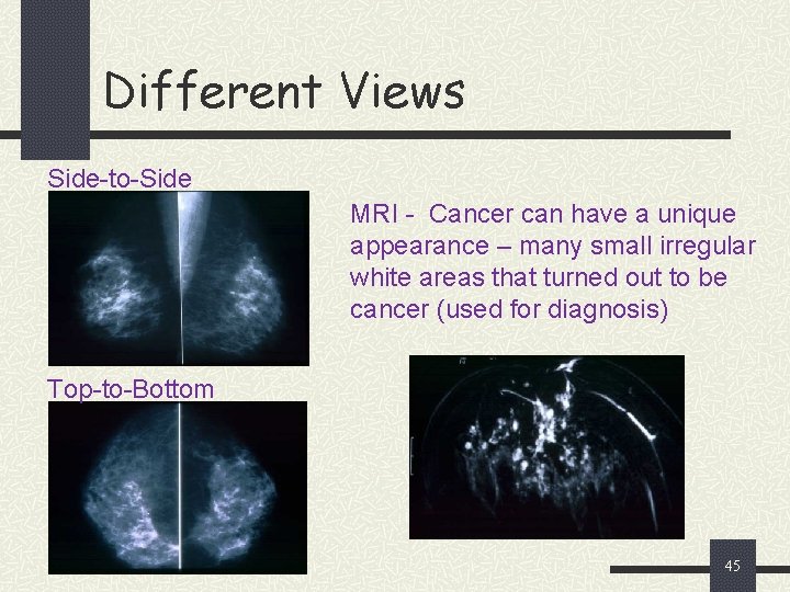 Different Views Side-to-Side MRI - Cancer can have a unique appearance – many small