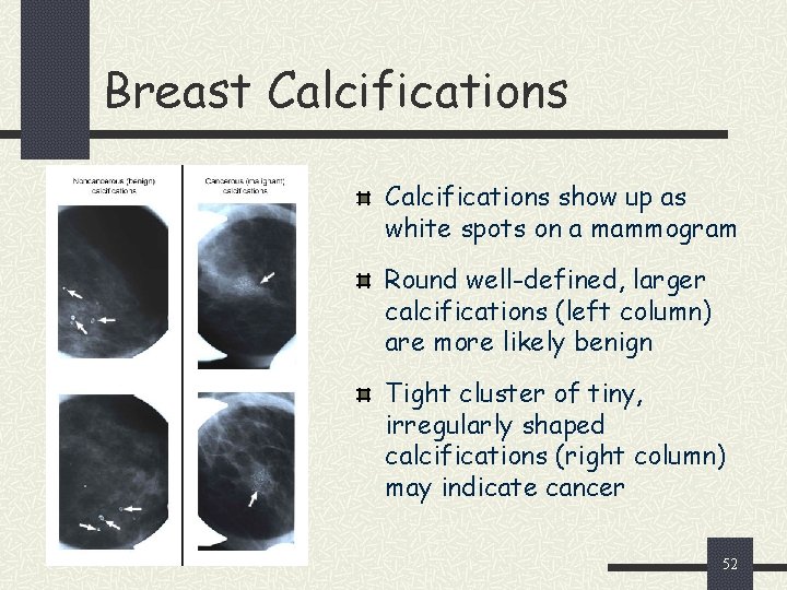 Breast Calcifications show up as white spots on a mammogram Round well-defined, larger calcifications