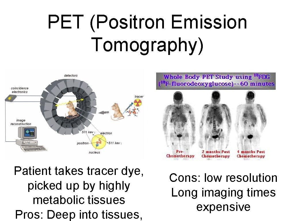 PET (Positron Emission Tomography) Patient takes tracer dye, picked up by highly metabolic tissues