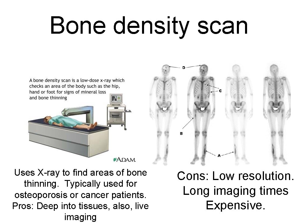 Bone density scan Uses X-ray to find areas of bone thinning. Typically used for