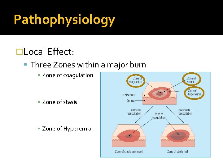 Pathophysiology �Local Effect: Three Zones within a major burn ▪ Zone of coagulation ▪