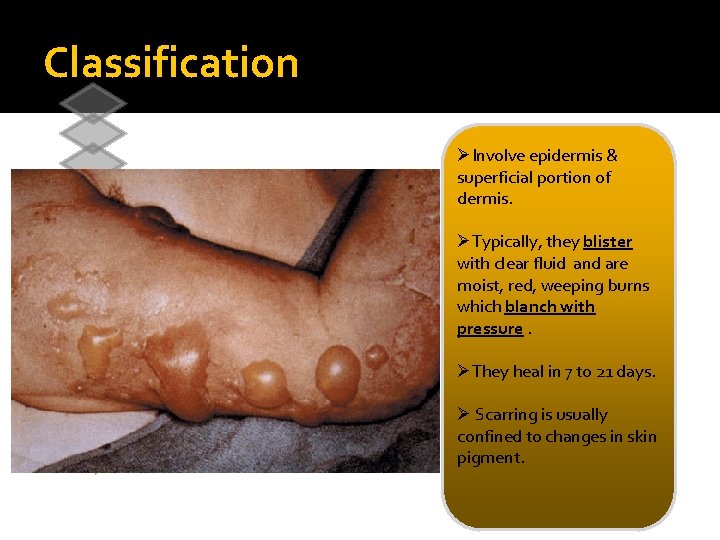 Classification 1 Superficial burns 1 st degree 2 Superficial partial-thickness 2 nd degree 3