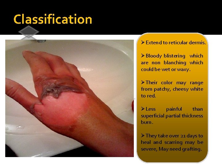 Classification ØExtend to reticular dermis. 1 Superficial burns 1 st degree 2 Superficial partial-thickness
