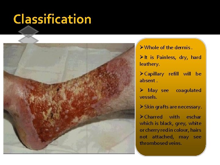 Classification ØWhole of the dermis. 1 2 3 Superficial burns 1 st degree Superficial