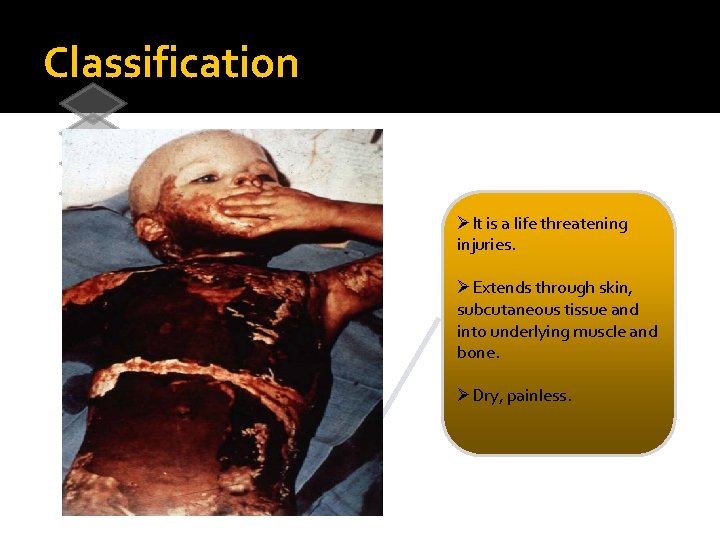Classification 1 Superficial burns 1 st degree 2 Superficial partial-thickness 2 nd degree 3