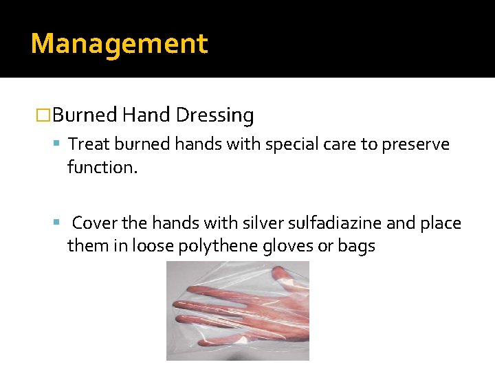 Management �Burned Hand Dressing Treat burned hands with special care to preserve function. Cover