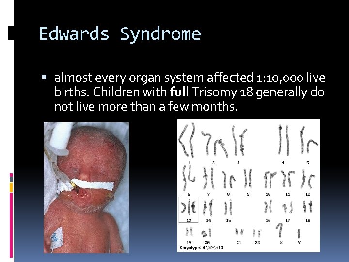 Edwards Syndrome almost every organ system affected 1: 10, 000 live births. Children with