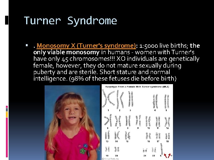 Turner Syndrome . Monosomy X (Turner's syndrome): 1: 5000 live births; the only viable