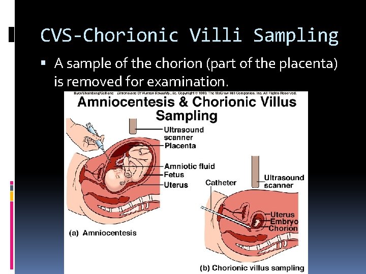 CVS-Chorionic Villi Sampling A sample of the chorion (part of the placenta) is removed