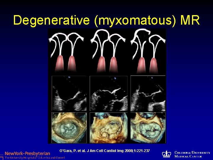 Degenerative (myxomatous) MR O'Gara, P. et al. J Am Coll Cardiol Img 2008; 1: