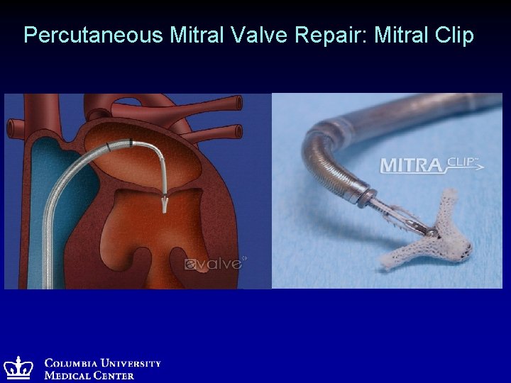 Percutaneous Mitral Valve Repair: Mitral Clip 