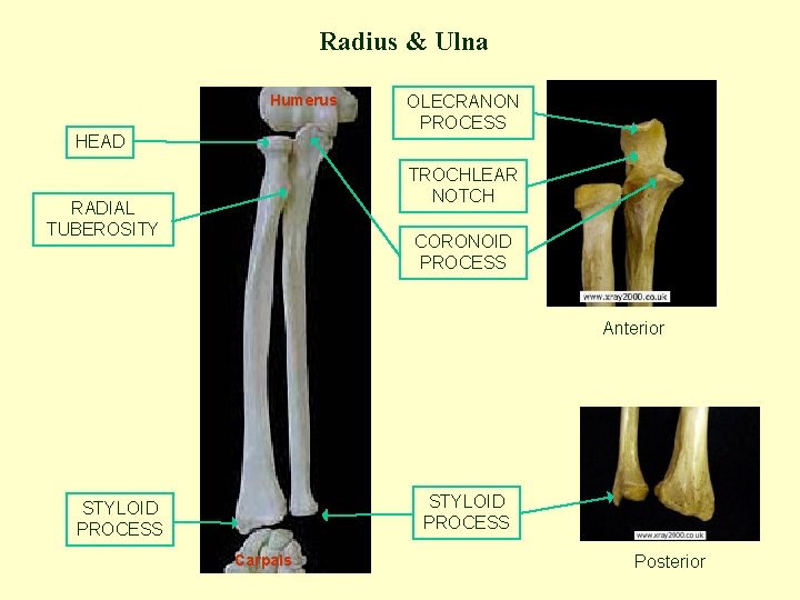 Radius & Ulna Humerus HEAD OLECRANON PROCESS TROCHLEAR NOTCH RADIAL TUBEROSITY CORONOID PROCESS Anterior