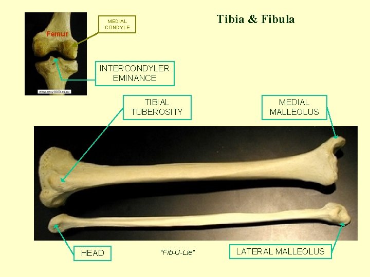 Tibia & Fibula MEDIAL CONDYLE Femur INTERCONDYLER EMINANCE TIBIAL TUBEROSITY HEAD “Fib-U-Lie” MEDIAL MALLEOLUS