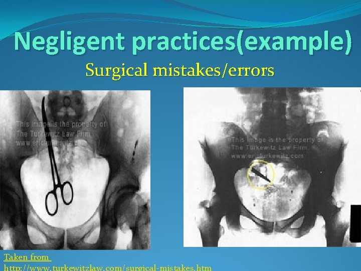 Negligent practices(example) Surgical mistakes/errors Taken from 