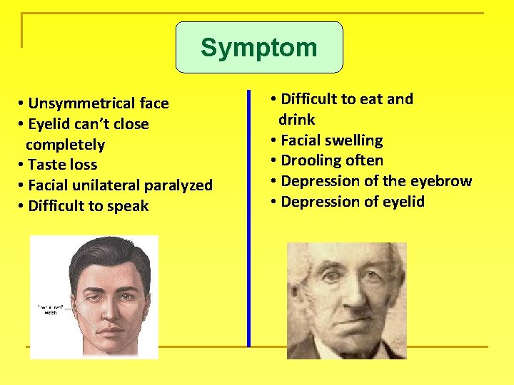 Symptom • Unsymmetrical face • Eyelid can’t close completely • Taste loss • Facial