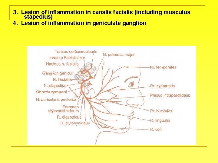 3. Lesion of inflammation in canalis facialis (including musculus stapedius) 4. Lesion of inflammation