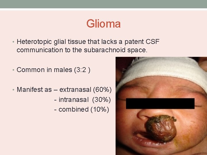 Glioma • Heterotopic glial tissue that lacks a patent CSF communication to the subarachnoid