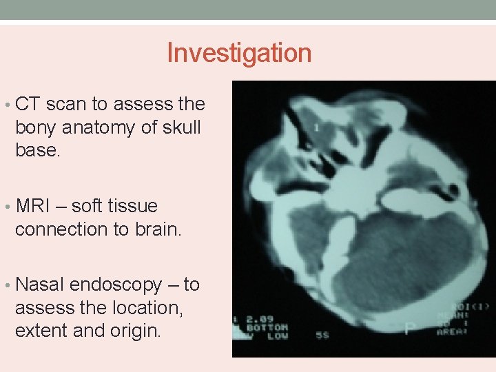 Investigation • CT scan to assess the bony anatomy of skull base. • MRI