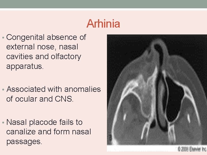 Arhinia • Congenital absence of external nose, nasal cavities and olfactory apparatus. • Associated