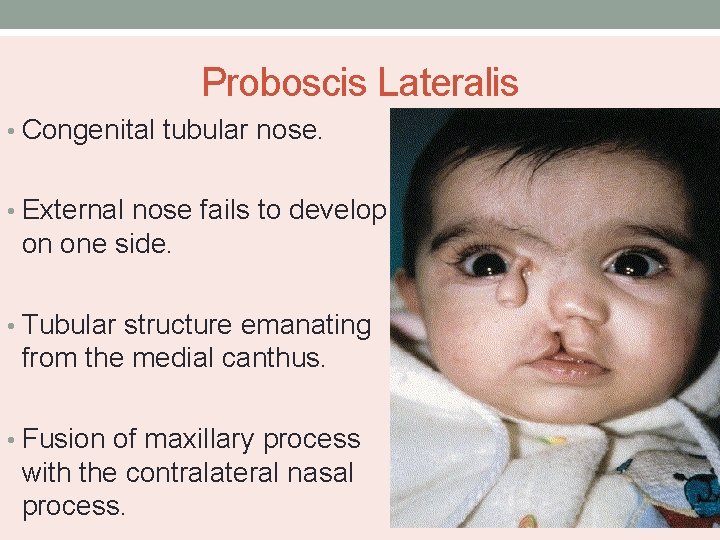 Proboscis Lateralis • Congenital tubular nose. • External nose fails to develop on one