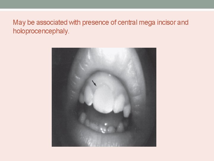 May be associated with presence of central mega incisor and holoprocencephaly. 