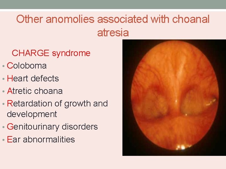 Other anomolies associated with choanal atresia CHARGE syndrome • Coloboma • Heart defects •