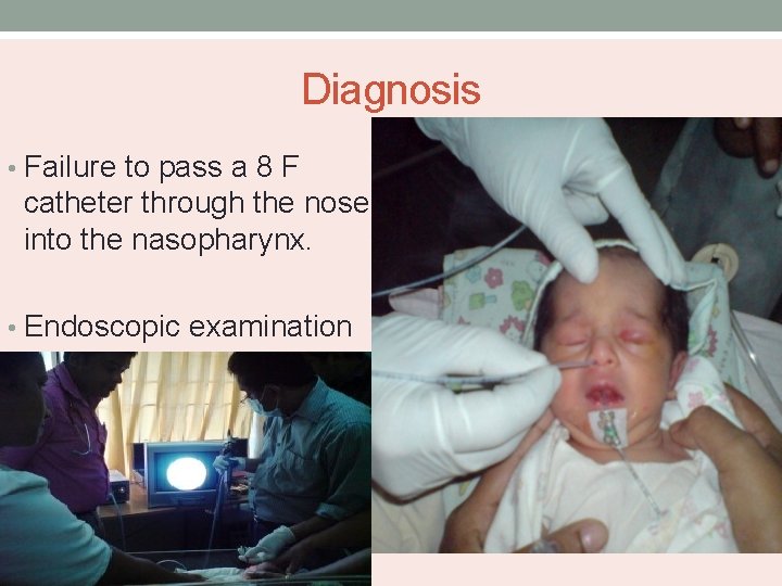 Diagnosis • Failure to pass a 8 F catheter through the nose into the