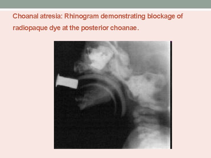 Choanal atresia: Rhinogram demonstrating blockage of radiopaque dye at the posterior choanae. 