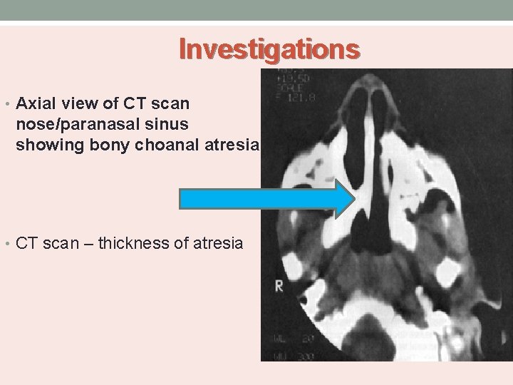 Investigations • Axial view of CT scan nose/paranasal sinus showing bony choanal atresia •