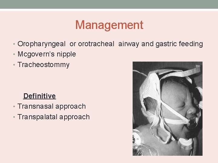 Management • Oropharyngeal or orotracheal airway and gastric feeding • Mcgovern’s nipple • Tracheostommy