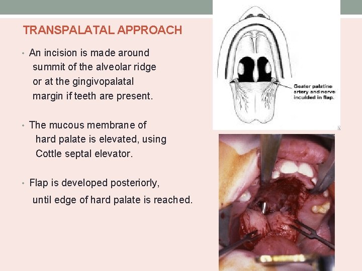 TRANSPALATAL APPROACH • An incision is made around summit of the alveolar ridge or