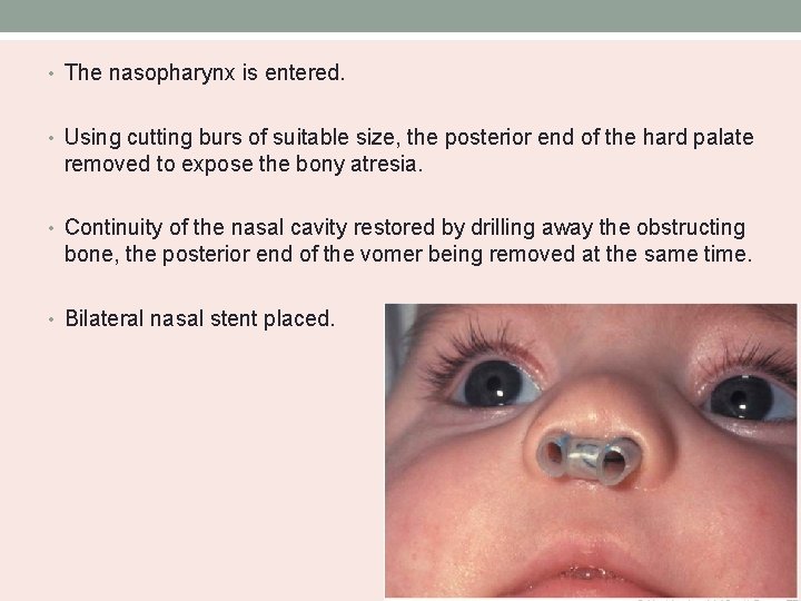  • The nasopharynx is entered. • Using cutting burs of suitable size, the