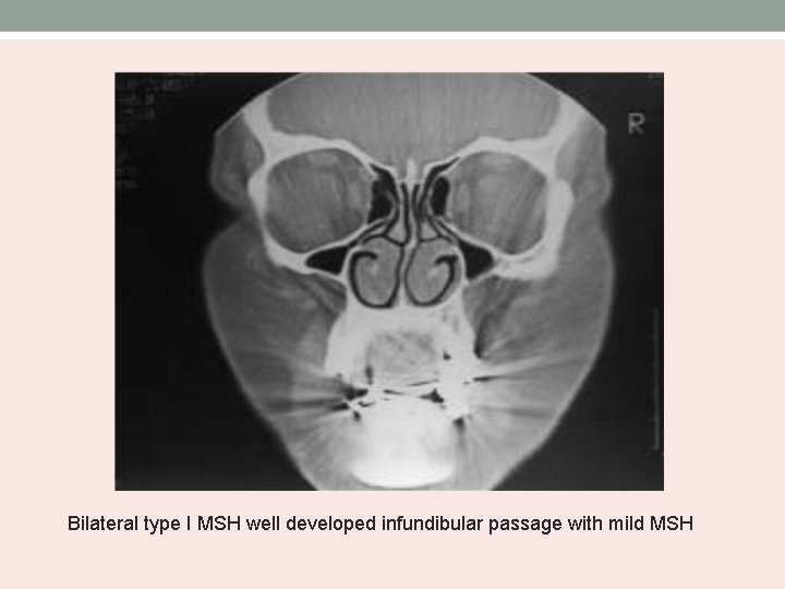 Bilateral type I MSH well developed infundibular passage with mild MSH 