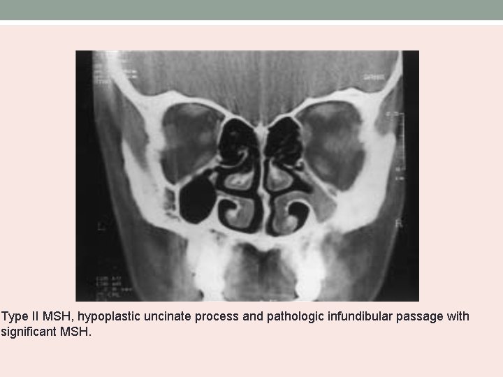 Type II MSH, hypoplastic uncinate process and pathologic infundibular passage with significant MSH. 