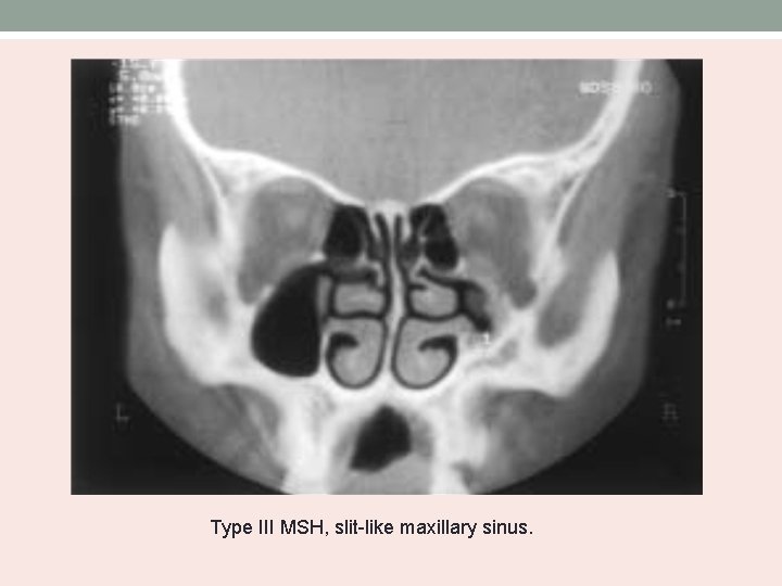 Type III MSH, slit-like maxillary sinus. 