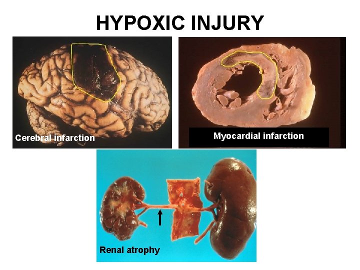HYPOXIC INJURY Myocardial infarction Cerebral infarction Renal atrophy 