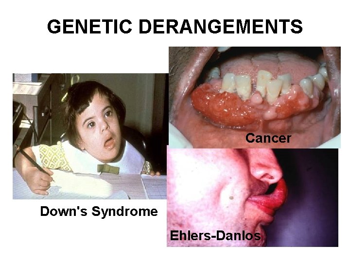 GENETIC DERANGEMENTS Cancer Down's Syndrome Ehlers-Danlos 