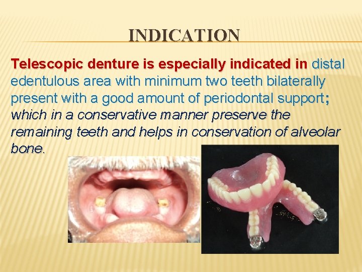 INDICATION Telescopic denture is especially indicated in distal edentulous area with minimum two teeth