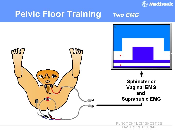 Pelvic Floor Training Two EMG Sphincter or Vaginal EMG and Suprapubic EMG FUNCTIONAL DIAGNOSTICS