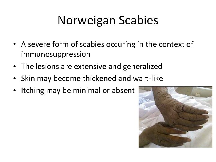 Norweigan Scabies • A severe form of scabies occuring in the context of immunosuppression