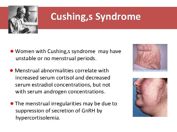 Cushing, s Syndrome ● Women with Cushing, s syndrome may have unstable or no