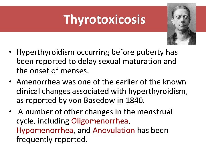 Thyrotoxicosis • Hyperthyroidism occurring before puberty has been reported to delay sexual maturation and